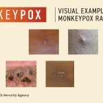 Monkeypox-Visuals-1200×675-02
