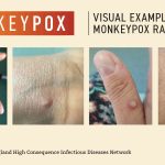 Monkeypox-Visuals-1200×675-1